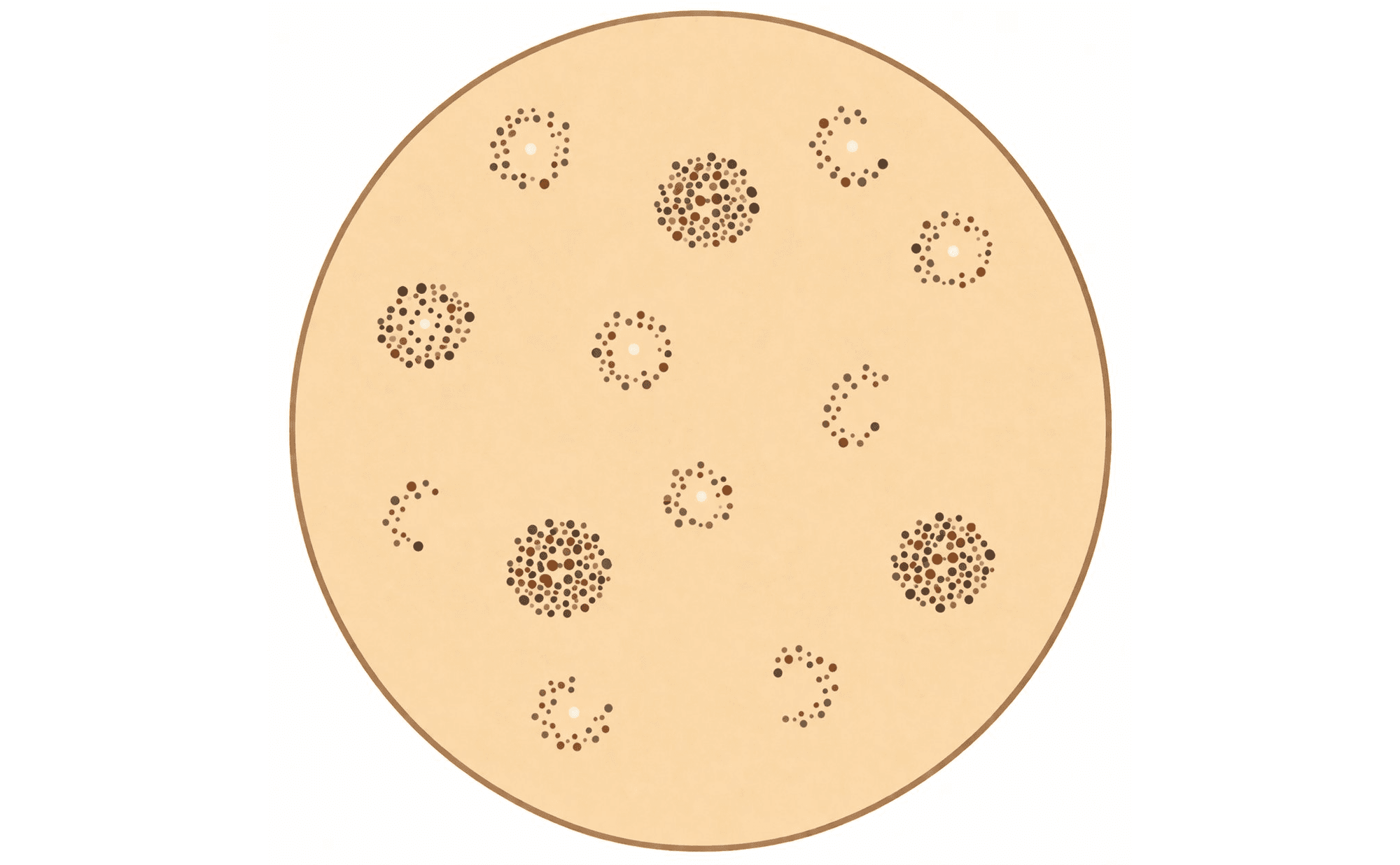 Dermoscopic illustration showing fine grey granules arranged in circular rings around follicular openings on sun-damaged facial skin
