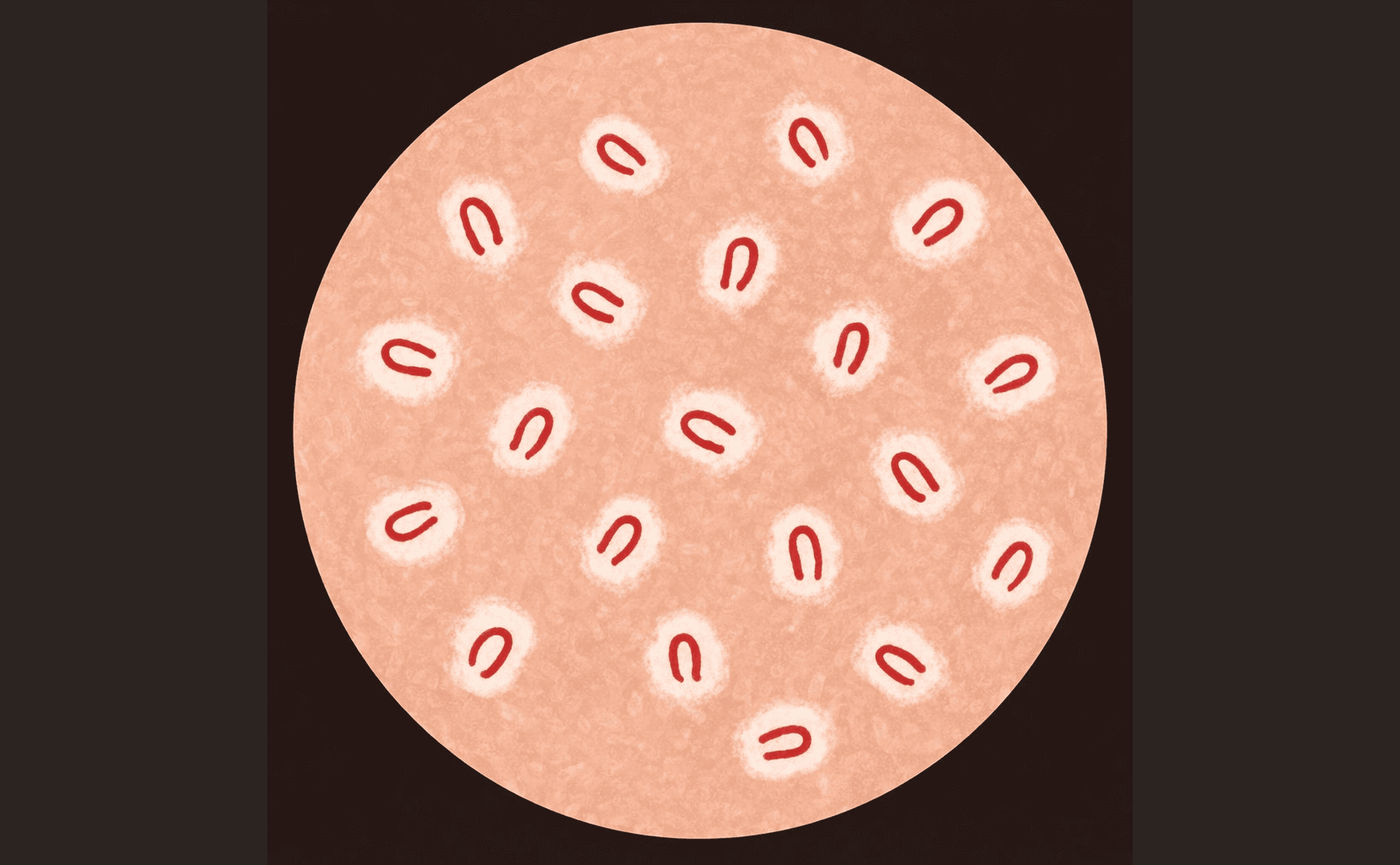 Dermoscopic illustration showing U-shaped hairpin vessels with surrounding white keratinous halos