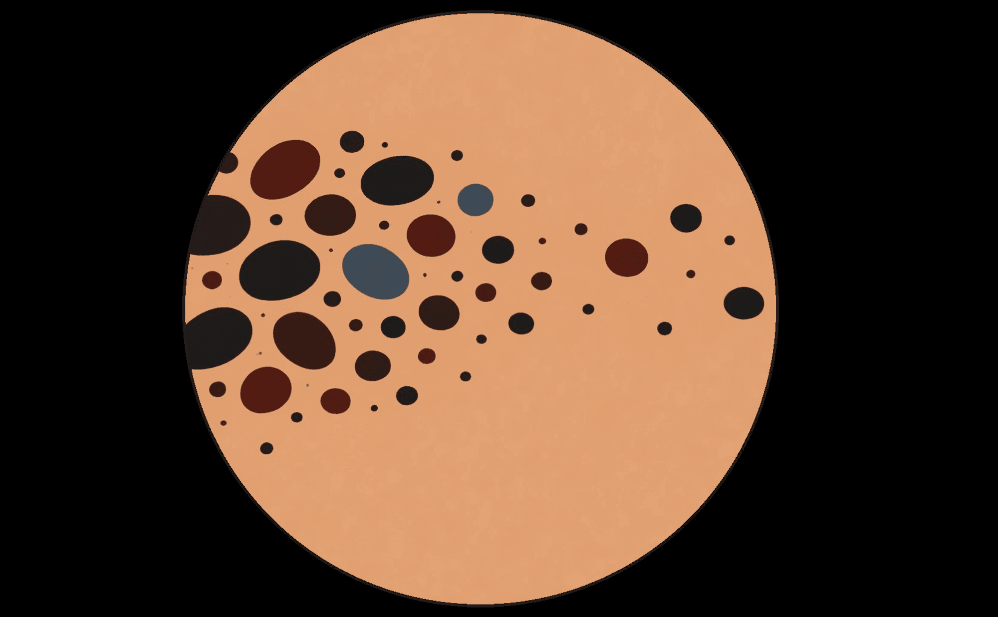 Dermoscopic illustration showing dots and globules of varying sizes scattered asymmetrically across a lesion