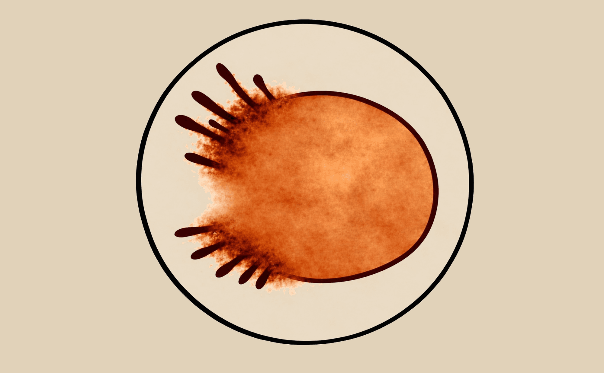 Dermoscopic illustration showing asymmetric radial projections at lesion periphery — variable length and thickness, present in some quadrants only