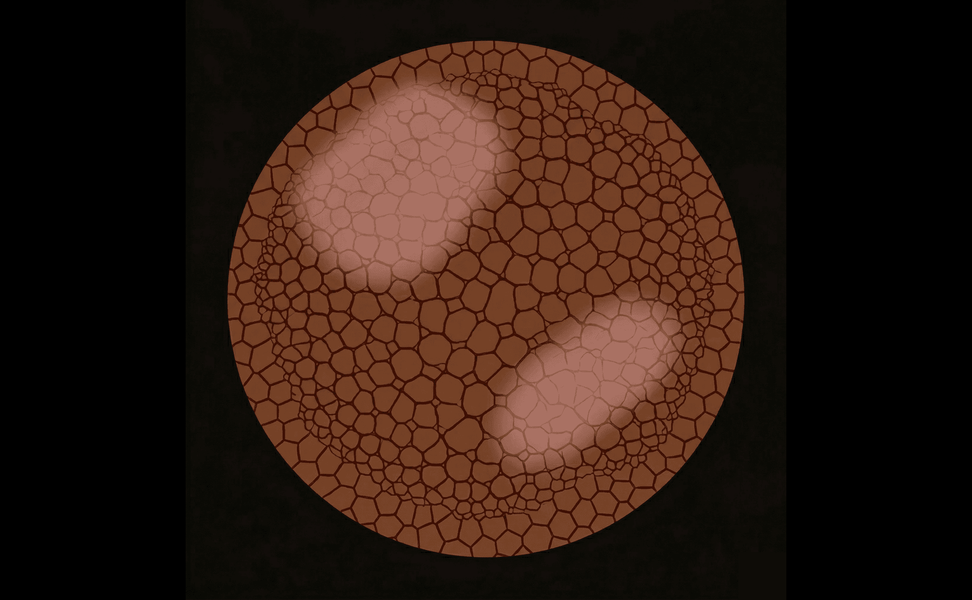 Dermoscopic illustration showing diffuse hazy pink-red zones where individual vessels cannot be resolved — a milky vascular blush
