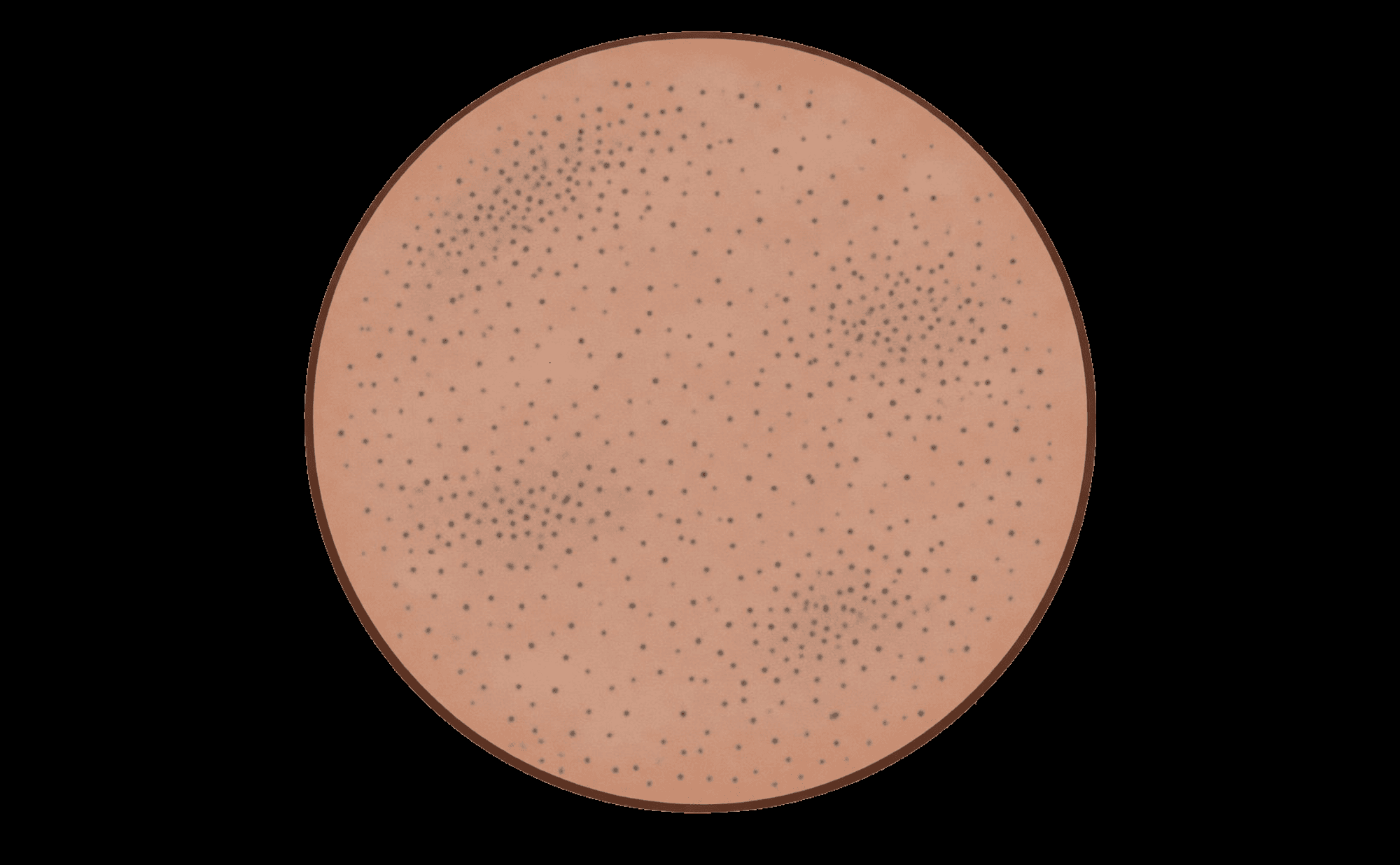Dermoscopic illustration showing fine grey-blue granules scattered like ground pepper across a lesion — melanin within melanophages