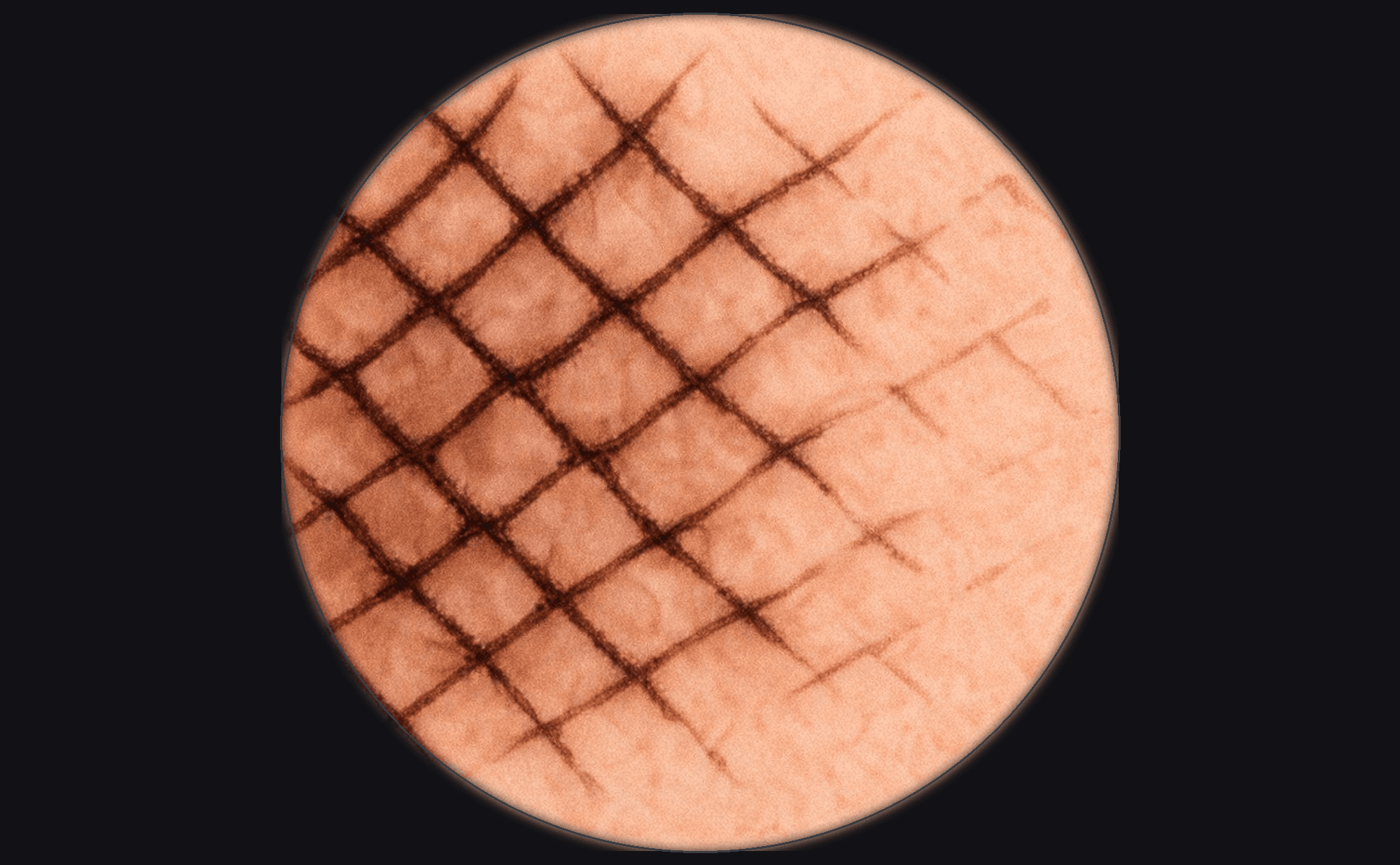 Dermoscopic illustration showing grey-brown pigmented lines forming diamond and rhomboid shapes between follicular openings on facial skin