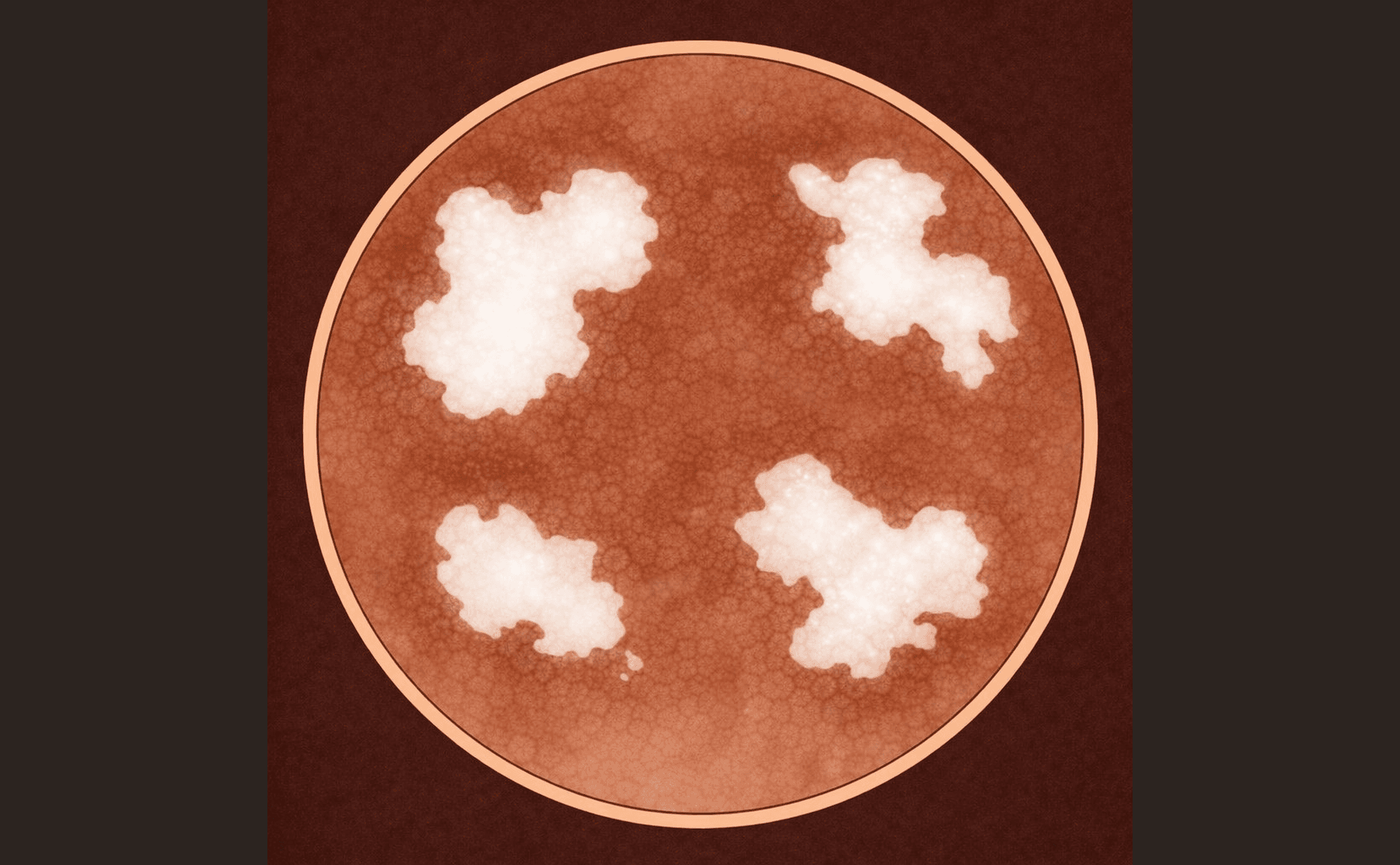 Dermoscopic illustration showing broader bright white patches visible under polarised light — larger and more confluent than individual shiny white lines