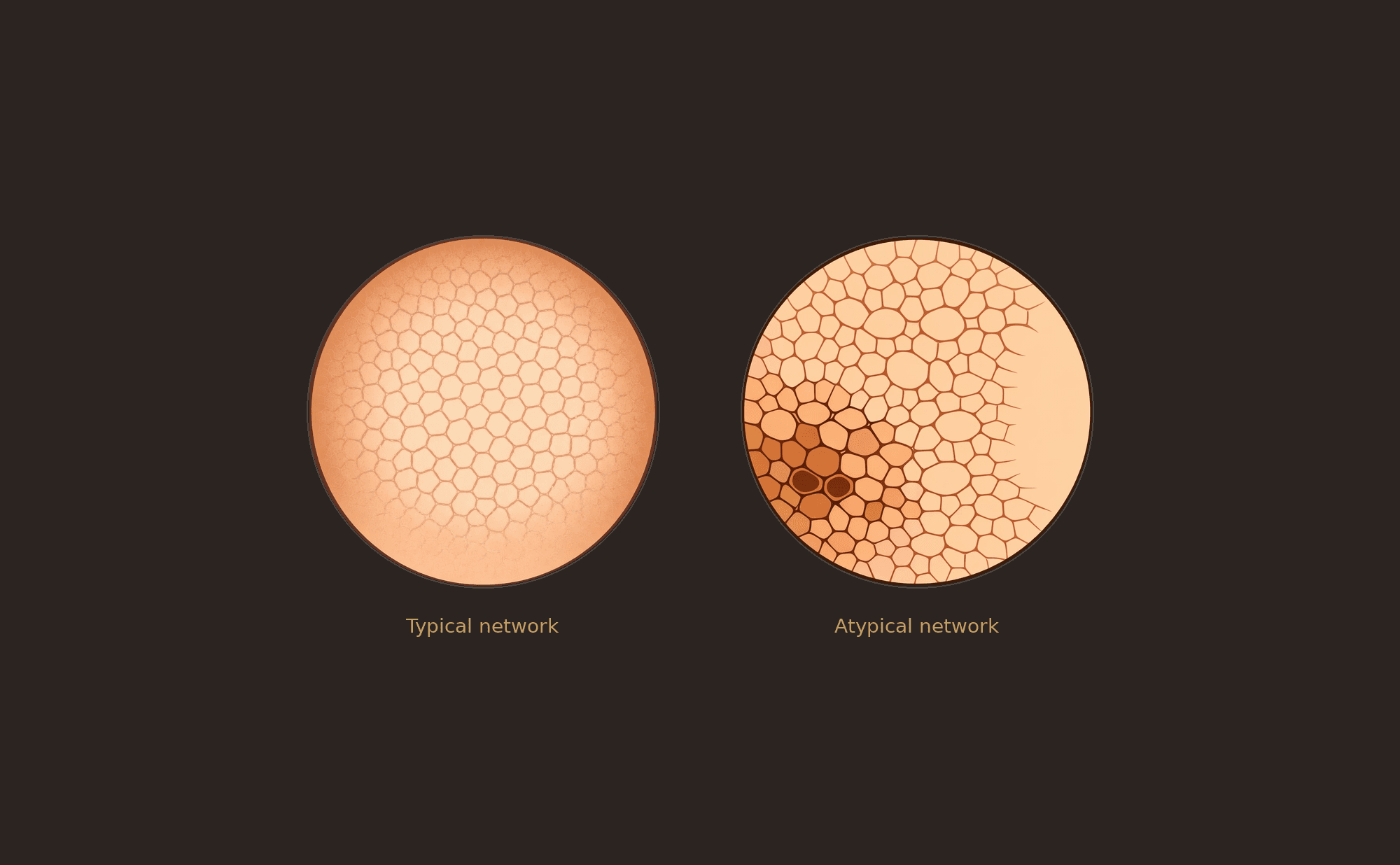 Side-by-side comparison showing a typical pigment network with regular spacing and uniform lines alongside an atypical network with variable line thickness, irregular holes, and abrupt termination.