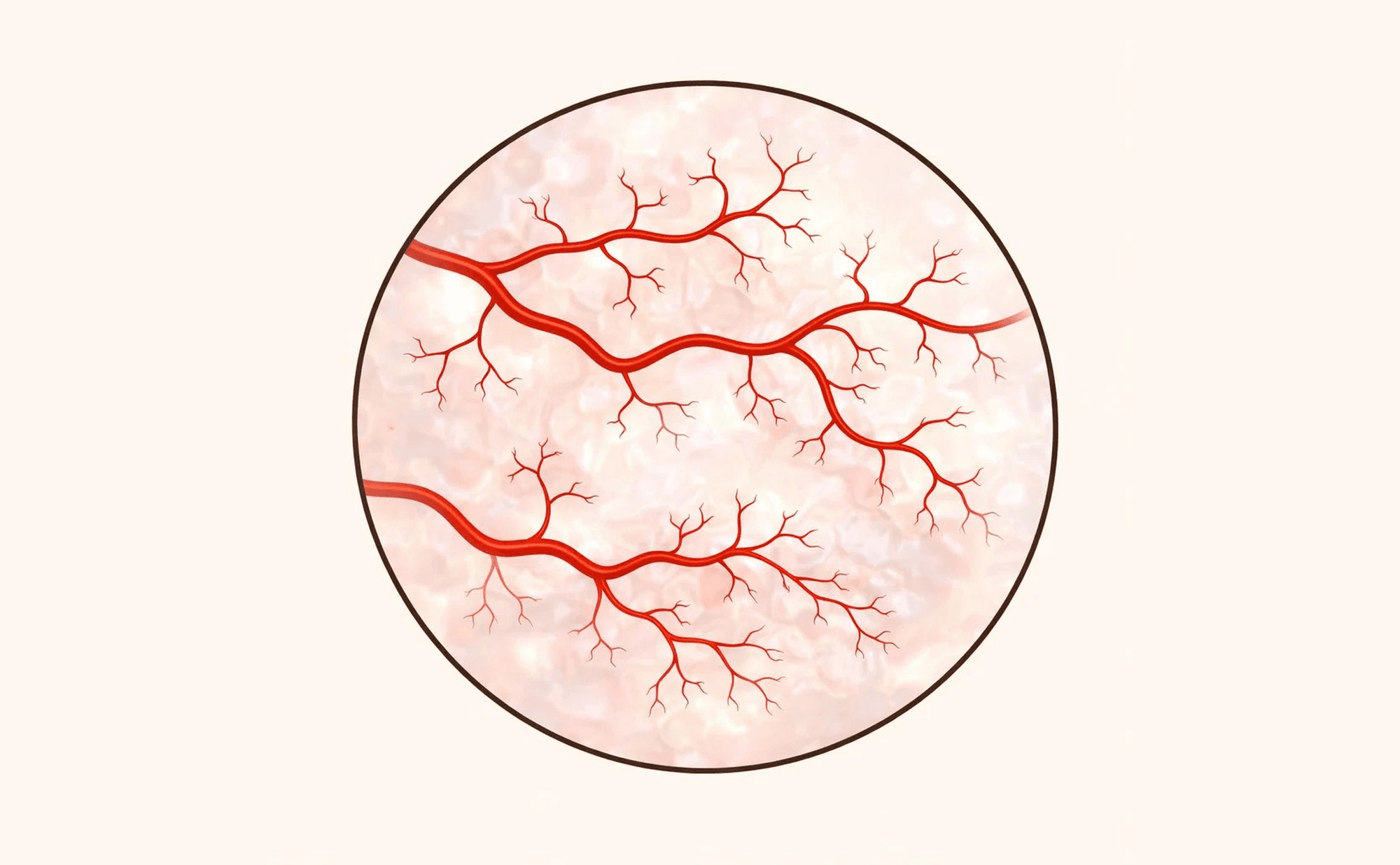 Dermoscopic illustration showing arborising vessels — tortuous bright red vessels with dichotomous branching and progressive calibre reduction on a pearly translucent background, characteristic of basal cell carcinoma.