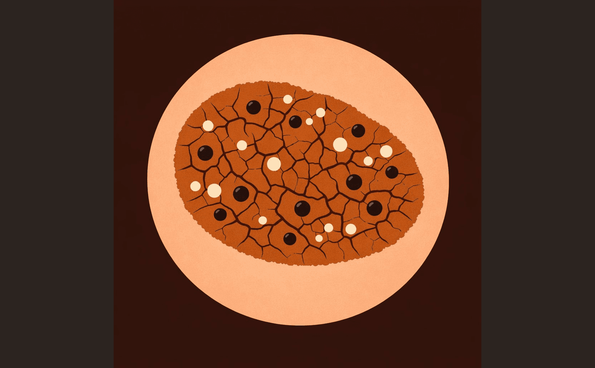 Dermoscopic view showing milia-like cysts, comedo-like openings, and brain-like fissures characteristic of seborrhoeic keratosis